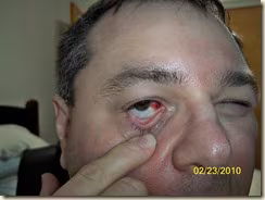 My Eye My Eye!