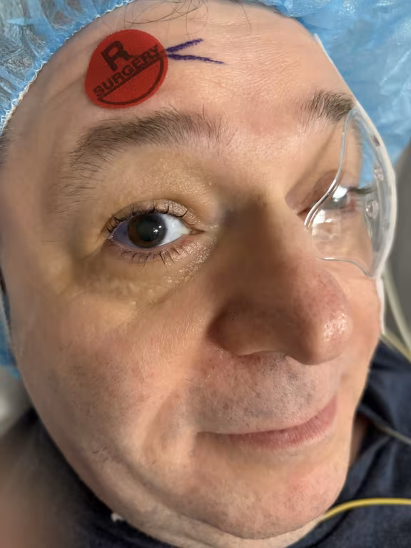 Close-up image of a middle-aged man’s face, showing his right eye and part of his nose and mouth. He is wearing a blue surgical cap covering his hair and clear protective goggles over his eyes. On his forehead, slightly above the right eyebrow, there is a red circular sticker with the text "R SURGERY" in black capital letters. Next to the sticker, two short purple lines are drawn on the skin, likely surgical markings. The man has light skin with some visible pores and slight stubble on his chin and upper lip. His right eye is open, looking slightly upward and to the left. The background is out of focus, emphasizing the man’s face and surgical preparation.