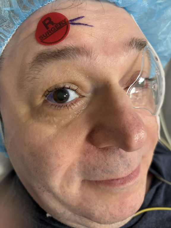 Close-up image of a middle-aged man’s face, showing his right eye and part of his nose and mouth. He is wearing a blue surgical cap covering his hair and clear protective goggles over his eyes. On his forehead, slightly above the right eyebrow, there is a red circular sticker with the text "R SURGERY" in black capital letters. Next to the sticker, two short purple lines are drawn on the skin, likely surgical markings. The man has light skin with some visible pores and slight stubble on his chin and upper lip. His right eye is open, looking slightly upward and to the left. The background is out of focus, emphasizing the man’s face and surgical preparation.